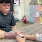 70%嚴重燒傷!30歲青年忍「皮膚撕裂」復健劇痛 半年重拾自主力